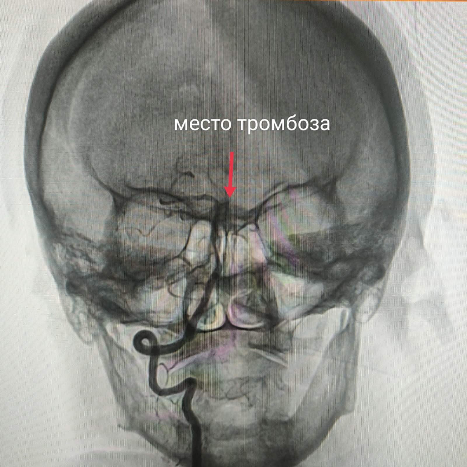 Ивановские медики провели уникальную операцию по удалению тромба